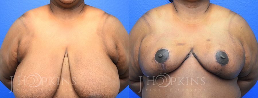 Breast Reduction - Case 10544