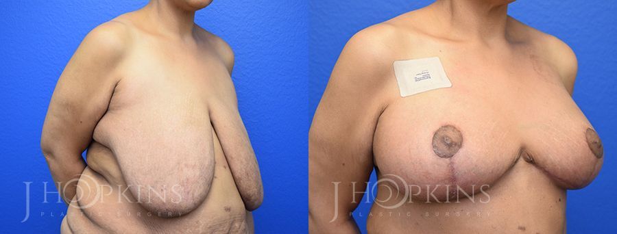 Breast Reduction - Thumbnail 2