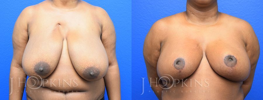 Breast Reduction - Case 10553