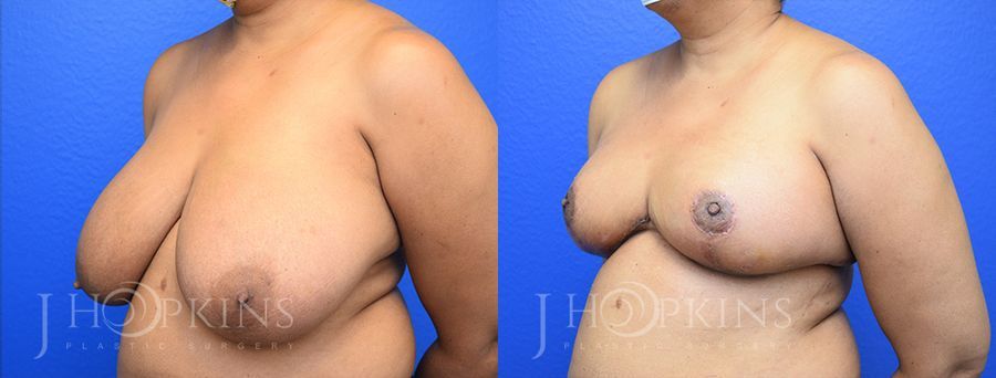 Breast Reduction - Thumbnail 2