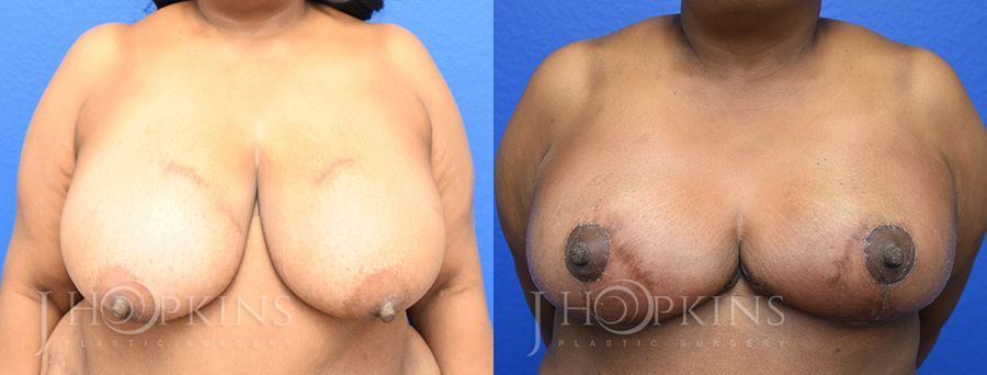 Breast Reduction - Case 10552