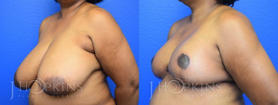 Breast Reduction - Thumbnail 2
