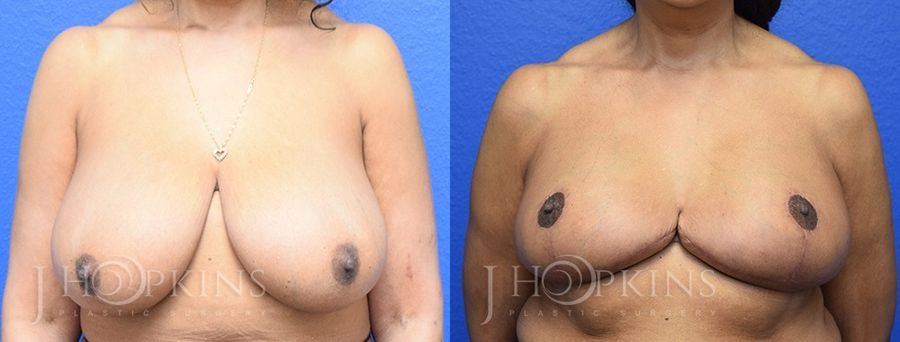 Breast Reduction - Case 10550