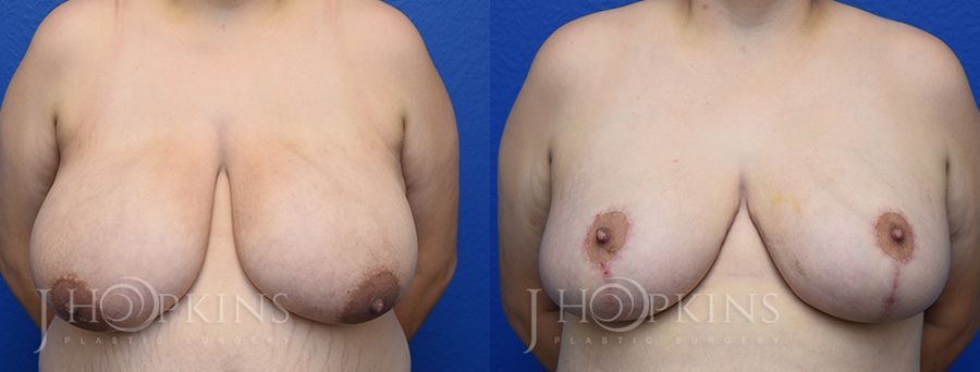 Breast Reduction - Case 10547