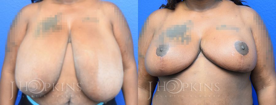 Breast Reduction - Case 10556