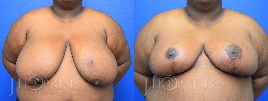 Breast Reduction - Case 10541