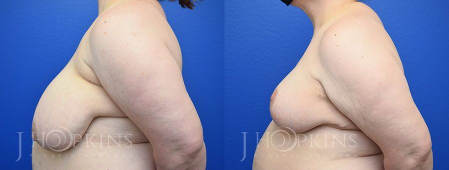 Breast Reduction - Thumbnail 2