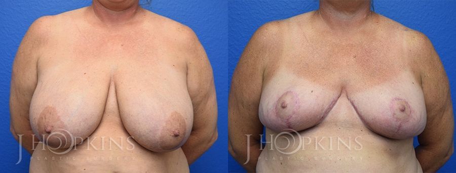 Breast Reduction - Case 10546