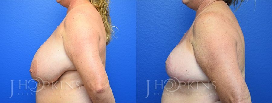 Breast Reduction - Thumbnail 2