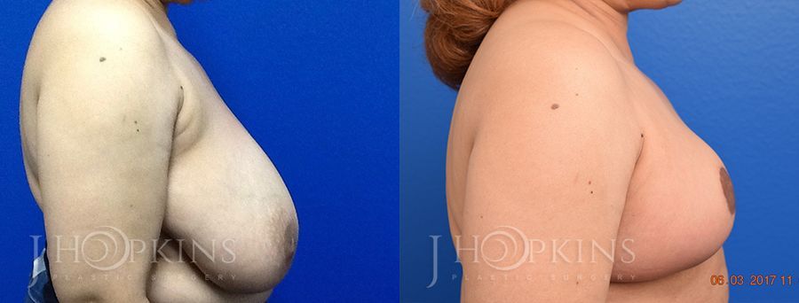 Breast Reduction - Thumbnail 2