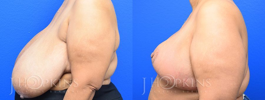 Breast Reduction - Thumbnail 2