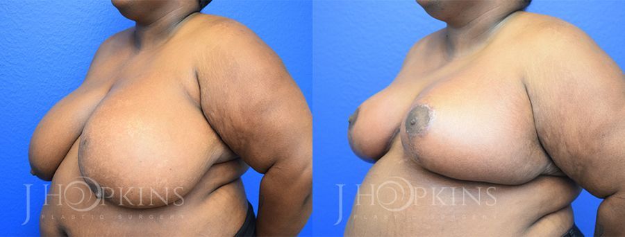 Breast Reduction - Thumbnail 2