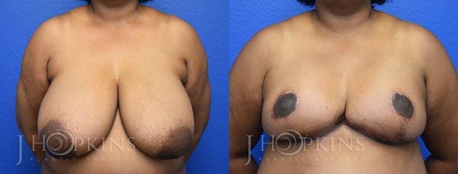 Breast Reduction - Case 10545