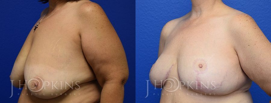 Breast Reduction - Thumbnail 2