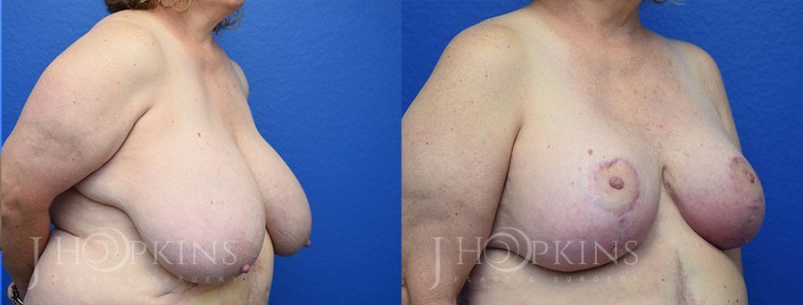 Breast Reduction - Thumbnail 2