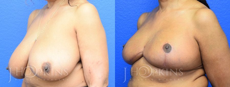 Breast Reduction - Thumbnail 2