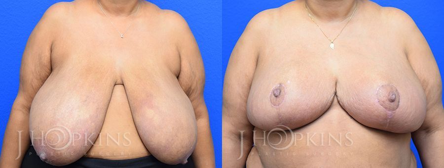 Breast Reduction - Case 10555