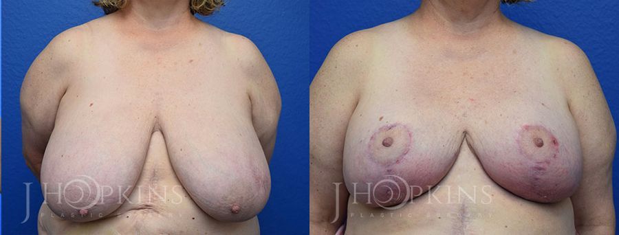 Breast Reduction - Case 10542