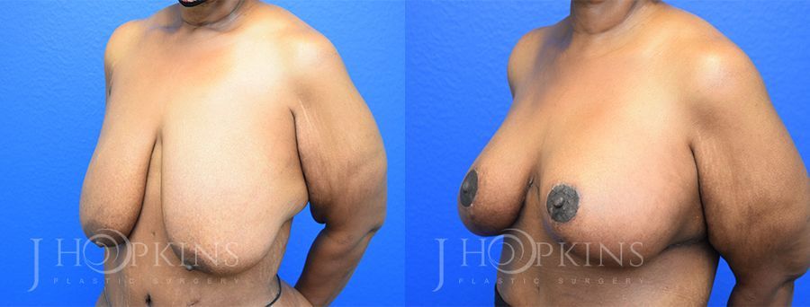 Breast Reduction - Thumbnail 2