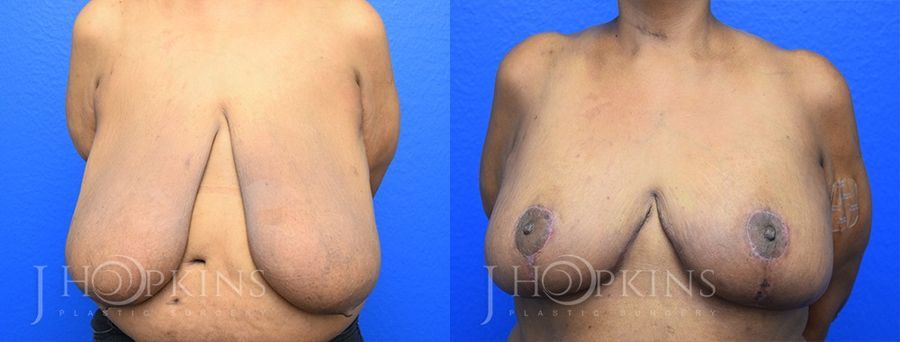 Breast Reduction - Case 10549