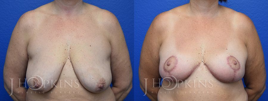 Breast Reduction - Case 10548