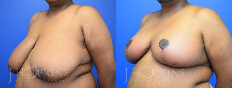 Breast Reduction - Thumbnail 2