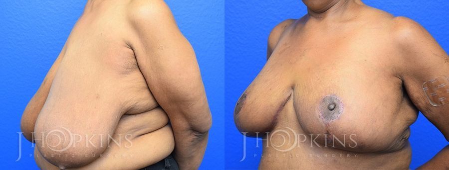 Breast Reduction - Thumbnail 2