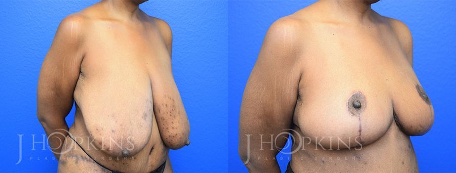 Breast Reduction - Thumbnail 2