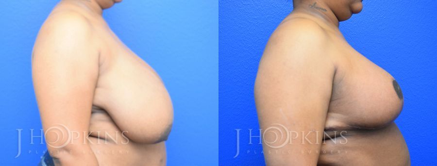 Breast Reduction - Thumbnail 2