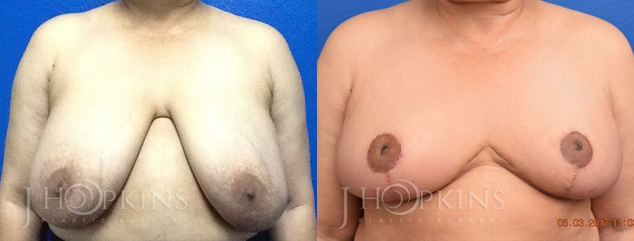 Breast Reduction - Case 10559