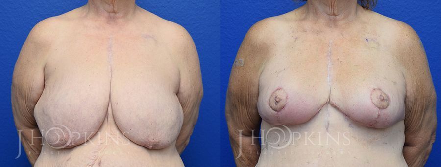 Breast Reduction - Case 10543