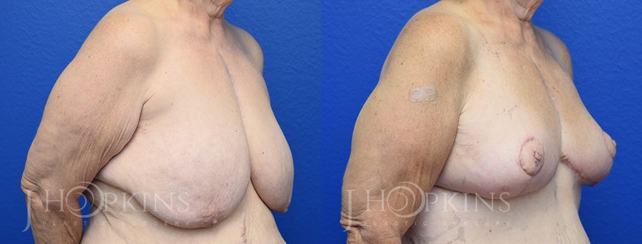 Breast Reduction - Thumbnail 2