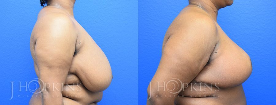 Breast Reduction - Thumbnail 2