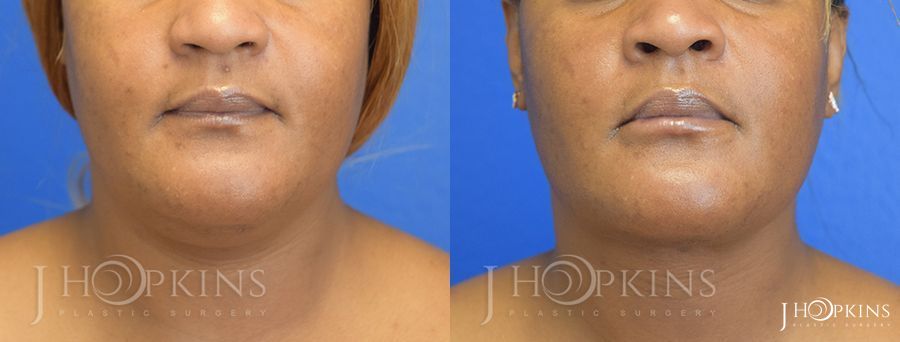 Chin Liposuction - Case 10580