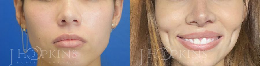 Dimple Creation - Case 10581