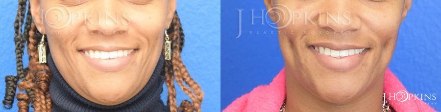 Dimples Johnson Ct Dimple Creation | J. Hopkins Plastic Surgery