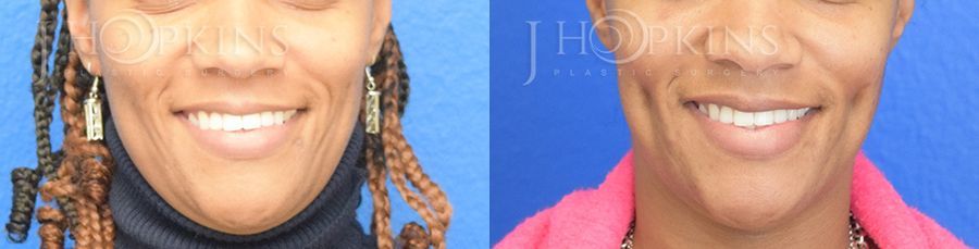 Dimple Creation - Case 10584