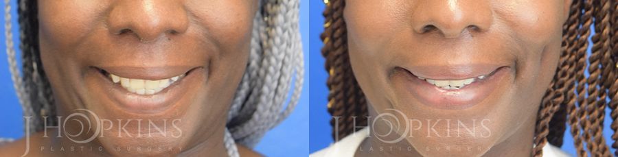 Dimple Creation - Case 10583