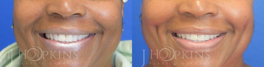 Dimple Creation - Case 10582