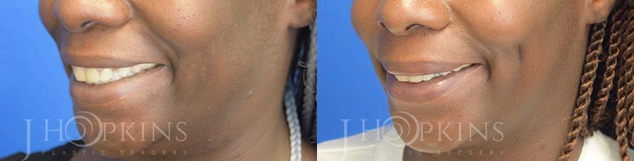 Dimple Creation - Thumbnail 2