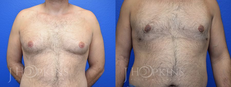 Gynecomastia - Case 10563
