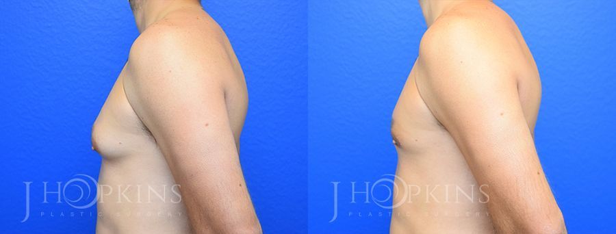 Gynecomastia - Thumbnail 2