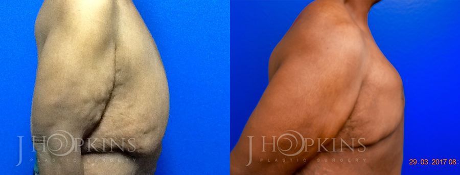 Gynecomastia - Thumbnail 2