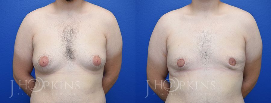 Gynecomastia - Case 10564