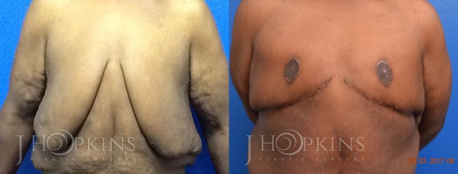 Gynecomastia - Case 10567