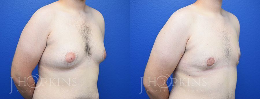 Gynecomastia - Thumbnail 2