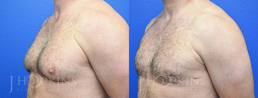 Gynecomastia - Thumbnail 2