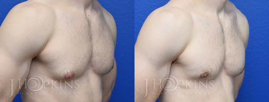 Gynecomastia - Thumbnail 2