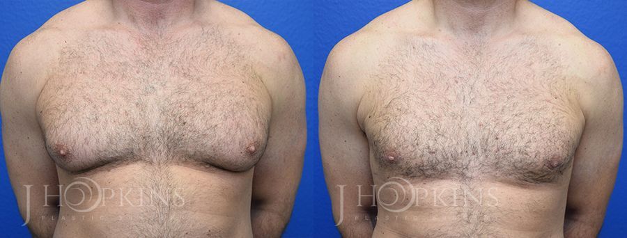 Gynecomastia - Case 10562
