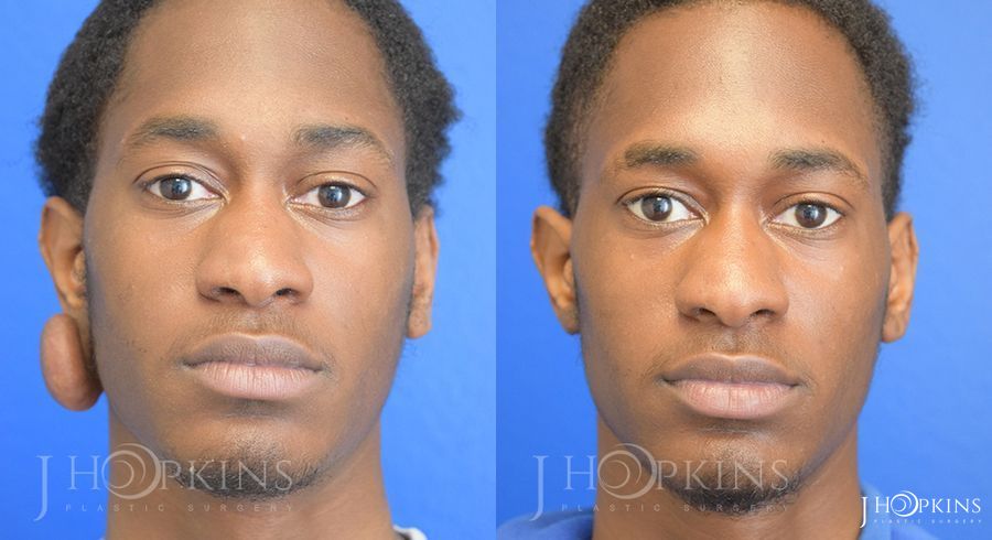 Keliod Scar Removal - Case 10585
